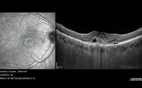 Fig. 1 Esempio di scansione OCT-EDI, con visualizzazione della retina e della coroide fino alla giunzione sclero-coroideale.