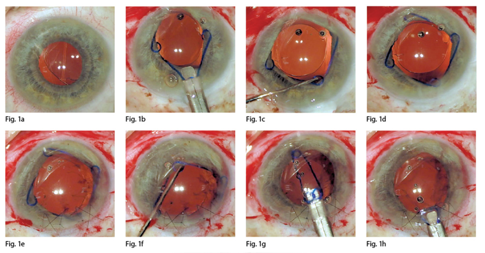 Figg. 1a-1h: inserimento e rimozione dell’anello in un caso di chirurgia combinata di impianto di iol a fissazione sclerale + vitrectomia.