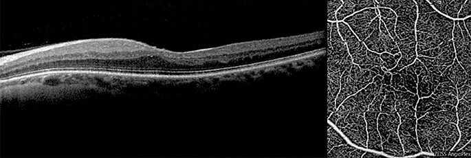Fig. 1 Caso di un paziente di 53 anni affetto da occlusione arteriosa di branca in occhio sinistro. A sinistra l’esame OCT mostra una perdita della fisiologica fossetta foveale ed un incremento dello spessore maculare centrale. A destra l’esame OCT-A mostra la presenza di una macular foveal capillaris (MFC). Cortesia del “Servizio di Retina Medica & Imaging”, responsabile Prof. Giuseppe Querques e Prof. Francesco Bandello, U.O. Oculistica, IRCCS Ospedale San Raffaele, Milano