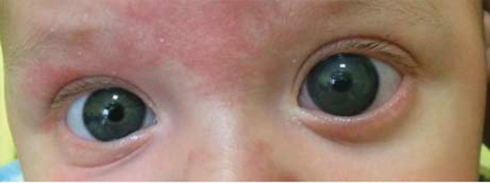 Fig. 3 Bambino con buftalmo in occhio sinistro.