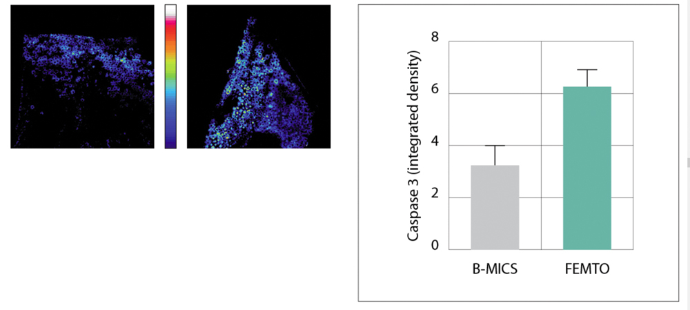 Fig. 3 Analisi semi-quantitativa dell’apoptosi in cellule epitelialidel cristallino, mediante immagini in pseudocolore e tramite analisi densitometrica dell’espressione della caspasi 3 attiva. ** p<0.01capsulotomia femtolaser vs capsuloressi manuale.