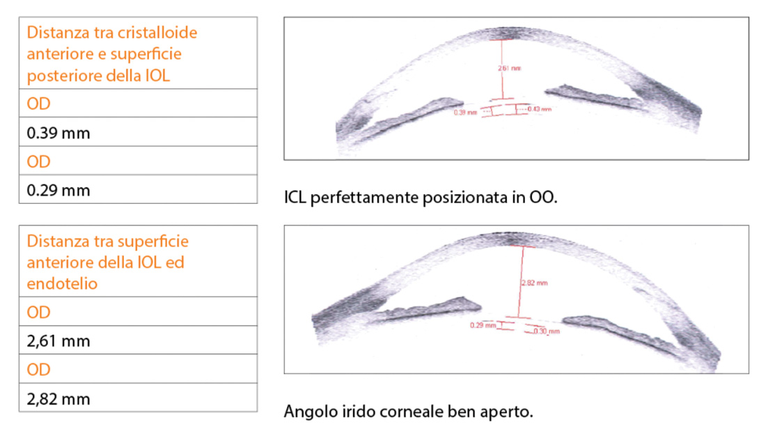 Angolo-irido-corneale