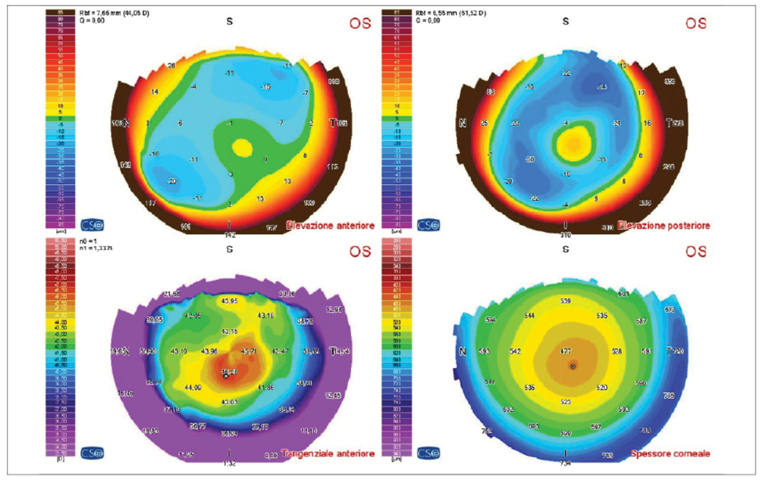 OCT: profilo della limitante interna con lieve irregolarità bilaterale, riduzione lieve della depressione foveale, irregolarità del complesso epitelio pigmentato coriocapillare come da quadro associato a miopia elevata.