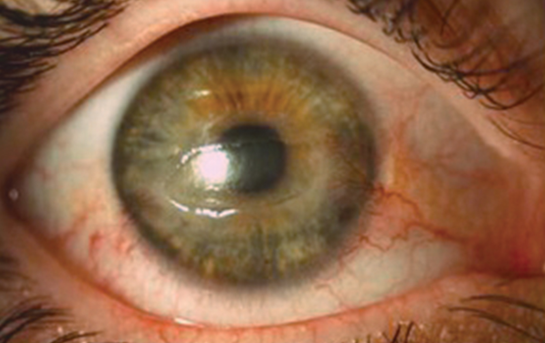Figg. 1: Due casi di cheratite neurotrofica, che mostrano un difetto epiteliale persistente, con margini arrotolati. localizzato nella cornea centrale, associato a lieve iperemia congiuntivale.