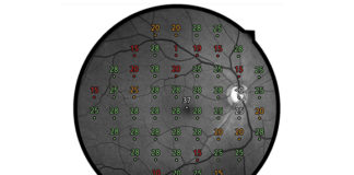 COMPASS Fundus Automated Perimetry