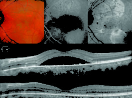 Caso di un paziente di 36 anni affetto da corioretinopatia sierosa centrale cronica in occhio sinistro e trattato con Eplerenone per 12 settimane. Nella riga superiore sono visibili l’immagine MultiColor, fluorangiografia e angiografia con verde d’indocianina prima dell’inizio del trattamento. Nella riga centrale, l’esame OCT mostra la presenza del fluido sottoretinico prima dell’inizio del trattamento che si è poi riassorbito dopo la terapia (riga inferiore). Cortesia del “Servizio di Retina Medica & Imaging”, responsabile Prof. Giuseppe Querques e Prof. Francesco Bandello, U.O. Oculistica, IRCCS Ospedale San Raffaele, Milano.