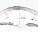 anisometropia miopica
