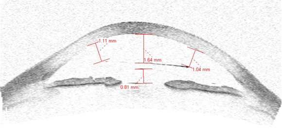 anisometropia miopica