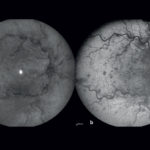Retinografia ad infrarosso (a) e autofluorescenza blu (b) dell’occhio destro.