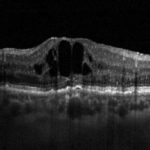 Fig. 1a OCT strutturale di un paziente affetto da EMD con scarsa risposta al precedente trattamento con 3 iniezioni di ranibizumab; il visus è 60 lettere ETDRS (20/63) e lo spessore retinico centrale è 630 µm.