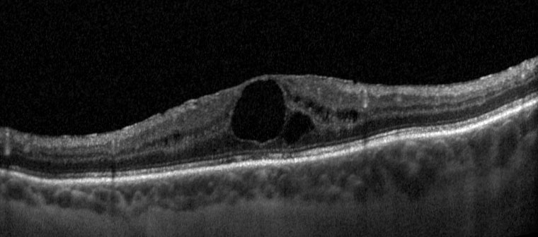 Fig. 2a OCT strutturale di una paziente affetta da EMD con buona risposta alle precedenti iniezioni di desametasone ma con tendenza a recidivare all’esaurimento del farmaco; il visus è 70 lettere ETDRS (20/40) e lo spessore retinico centrale è 491 µm. A causa della necessità di multiple iniezioni di desametasone, la paziente viene shiftata al trattamento con fluocinolone acetonide.