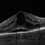 Fig. 3 OCT strutturale di un paziente affetto da EMD naïve. La scansione mostra la presenza di distacco sieroso del neuroepitelio e di numerosi foci iper-riflettenti, entrambi parametri morfologici associati ad un aumentato stato infiammatorio in occhi con EMD, potenzialmente più responsivi a una terapia con steroidi in prima linea.