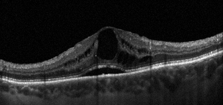 Fig. 3 OCT strutturale di un paziente affetto da EMD naïve. La scansione mostra la presenza di distacco sieroso del neuroepitelio e di numerosi foci iper-riflettenti, entrambi parametri morfologici associati ad un aumentato stato infiammatorio in occhi con EMD, potenzialmente più responsivi a una terapia con steroidi in prima linea.