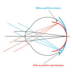 Fig. 4. Rappresentazione del defocus periferico miopico (rosso) e ipermetropico (blu) quando viene osservato un oggetto posto all’infinito ottico e la cui immagine cade in fovea.