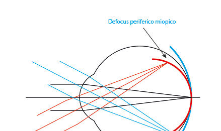 Fig. 4. Rappresentazione del defocus periferico miopico (rosso) e ipermetropico (blu) quando viene osservato un oggetto posto all’infinito ottico e la cui immagine cade in fovea.