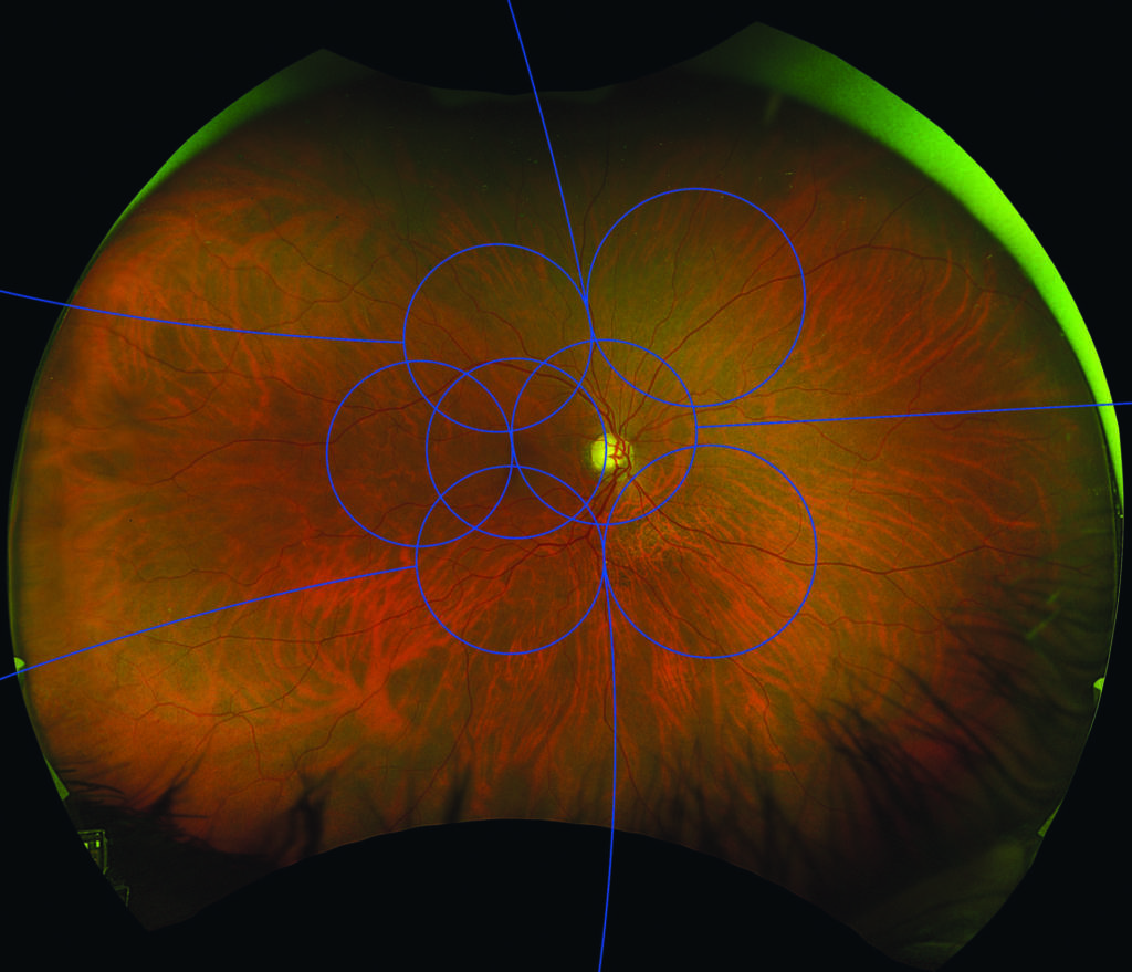 Fig. 1 Retinografia UWF di paziente con retinopatia diabetica iniziale. Si osservano rari microaneurismi in estrema periferia al difuori dei 7 campi ETDRS.