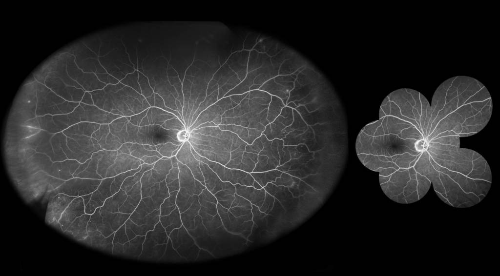 Fig. 2 Fluorangiografia UWF del paziente della figura 1. Si osservi il leakage perivascolare venoso in estrema periferia temporale. Lesioni microaneurismariche sono presenti anche in estrema periferia nasale.