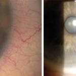 Aspetto alla lampada a fessura prima (sinistra) e dopo (destra) la biopsia.