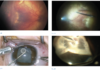 Fig. 1 Paziente con retinopatia del prematuro stadio 4. Foto fundus preoperatoria (Fig. 1A), immagine intraoperatoria durante vitrectomia (Fig. 1B). Fig. 2 Paziente con retinopatia del prematuro stadio 5. Immagine intraoperatoria durante lensectomia per via limbare (Fig. 2A), dissezione delle membrane (Fig. 2B).