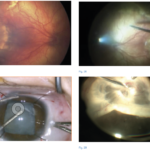 Fig. 1 Paziente con retinopatia del prematuro stadio 4. Foto fundus preoperatoria (Fig. 1A), immagine intraoperatoria durante vitrectomia (Fig. 1B). Fig. 2 Paziente con retinopatia del prematuro stadio 5. Immagine intraoperatoria durante lensectomia per via limbare (Fig. 2A), dissezione delle membrane (Fig. 2B).